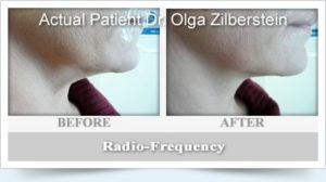 Radio-Frequency before and after pictures