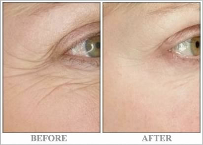Skin tightening treatment, Brookly and Long Island