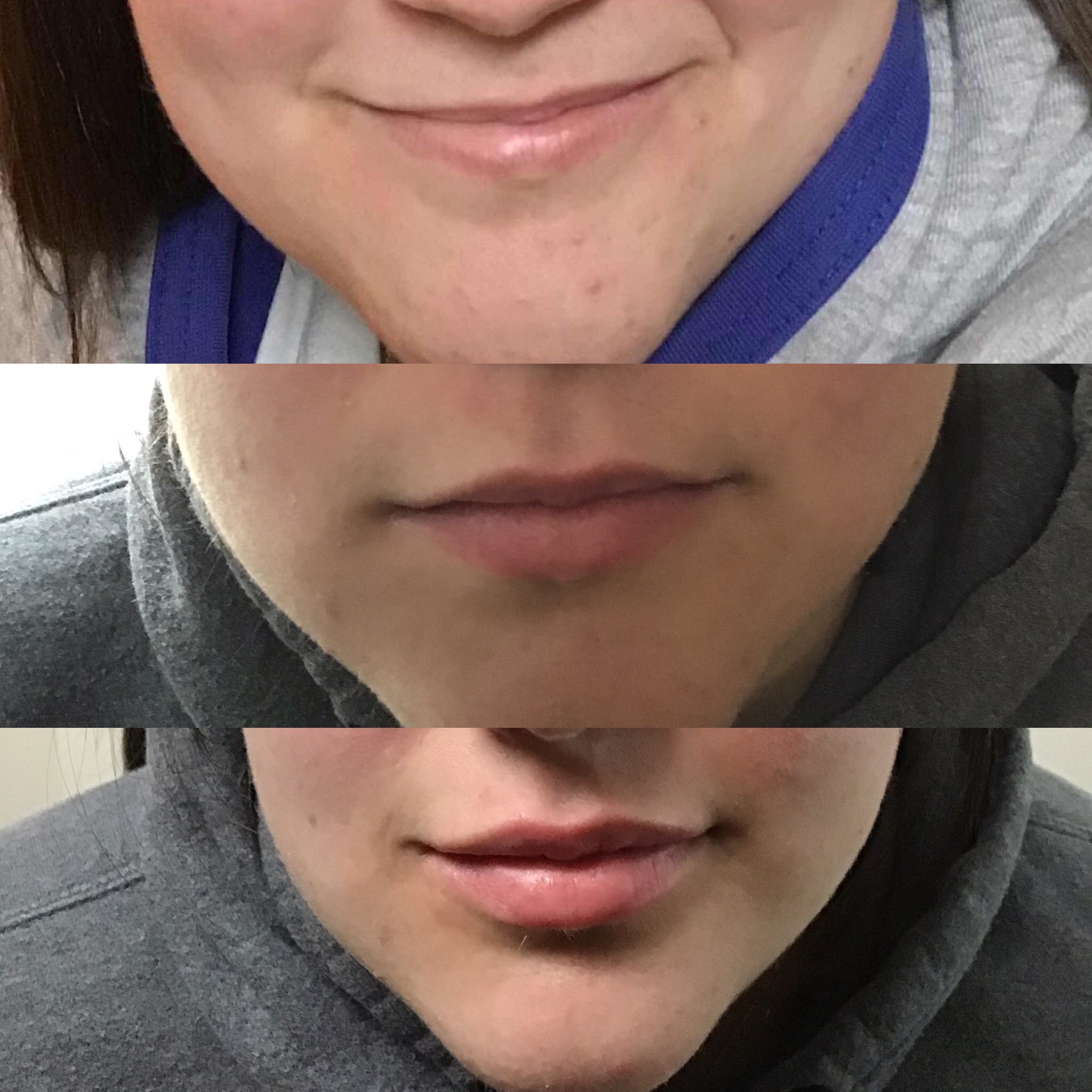 Lips Augmentation Long Island Dr. Olga Zilberstein