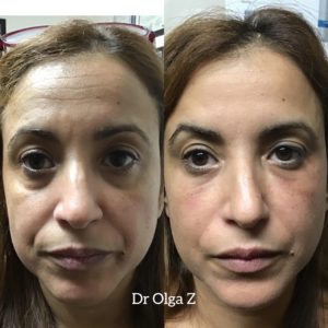 non surgical face lift long island before and after picture