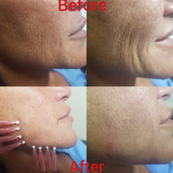 PDO/PCL ThreadLift Dr. Olga Zilberstein