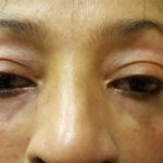 after_under_eyes_bags