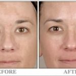 before-after-spot_treatment2