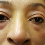 before_under_eyes_bags