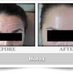 Botox treatment Brooklyn, NY
