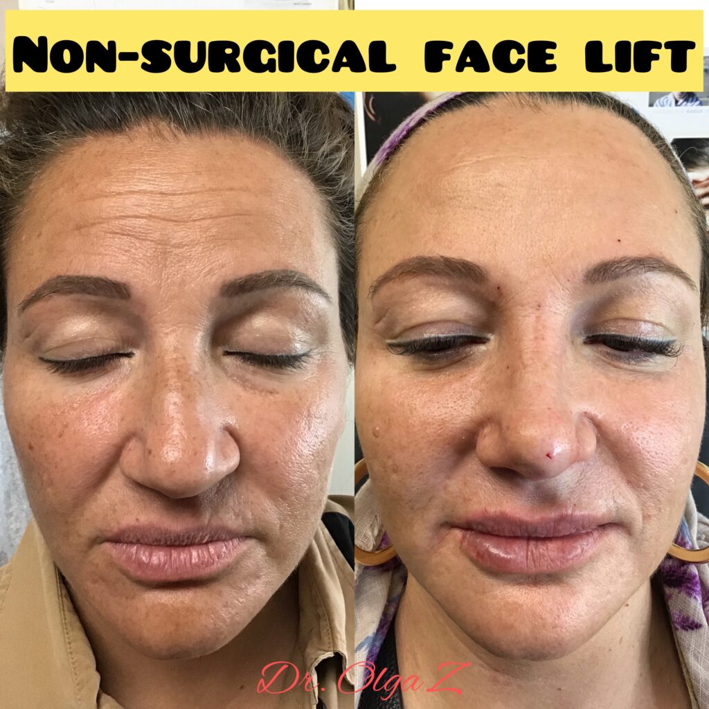 NonSurgical Face Lift Dr. Olga Zilberstein