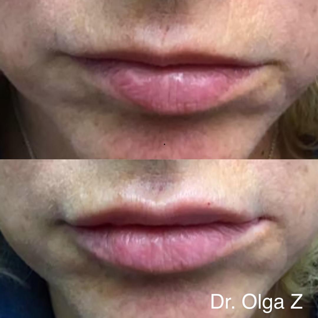 Lip enhancement near me
