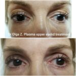 Plasma_Pen_upper_eyelid_treatment