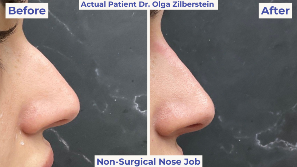 Before and After images of a non-surgical nose job