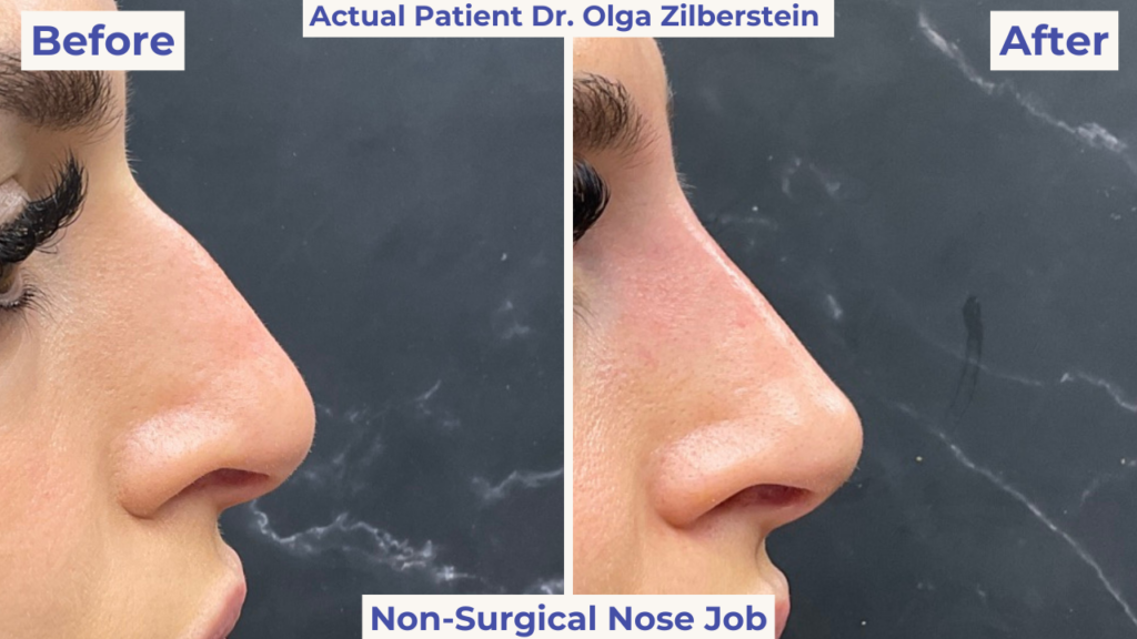 Before and After images of a non-surgical nose job