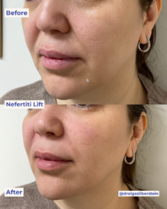 Nefertiti Lift botox performed by Dr Olga Zilberstein