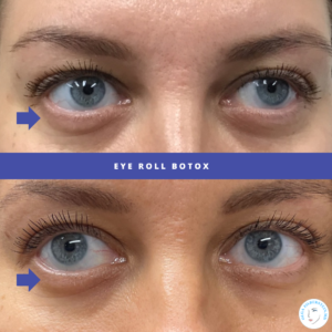Under-Eye Jelly Roll Botox performed by Dr Olga Zilberstein