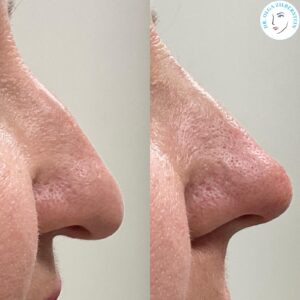 Two side-by-side close-ups of a nose, left with flaky dry skin and right with smoother skin, a before/after comparison from a dermatology treatment.
